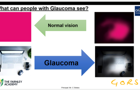 Gluacoma