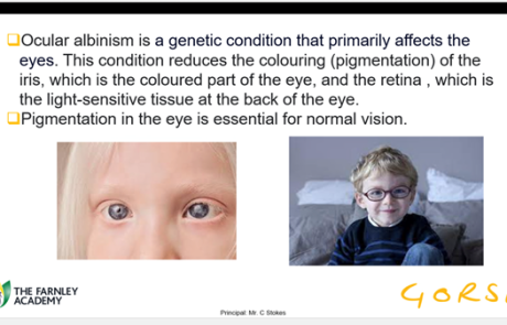 Ocular Albinism